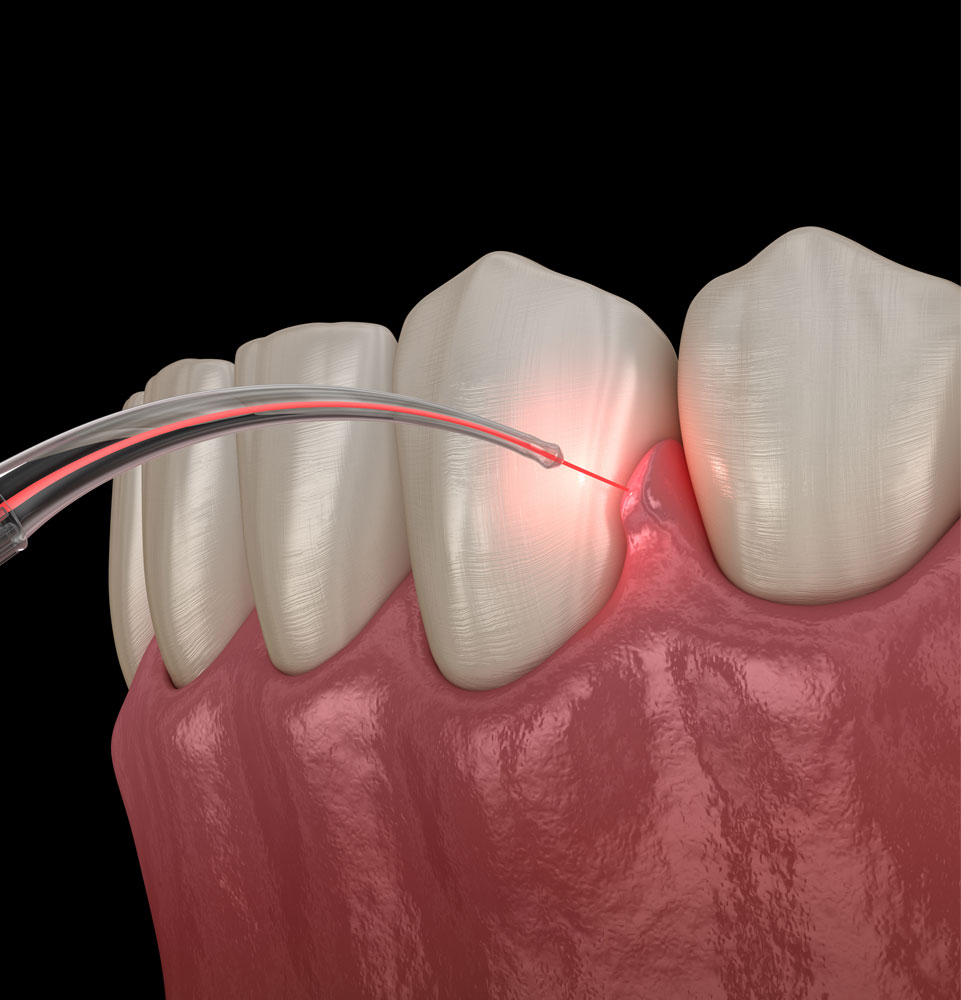 laser dentistry graphic