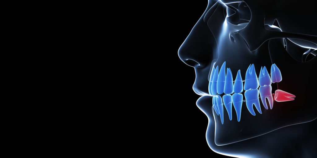 impacted wisdom tooth graphic