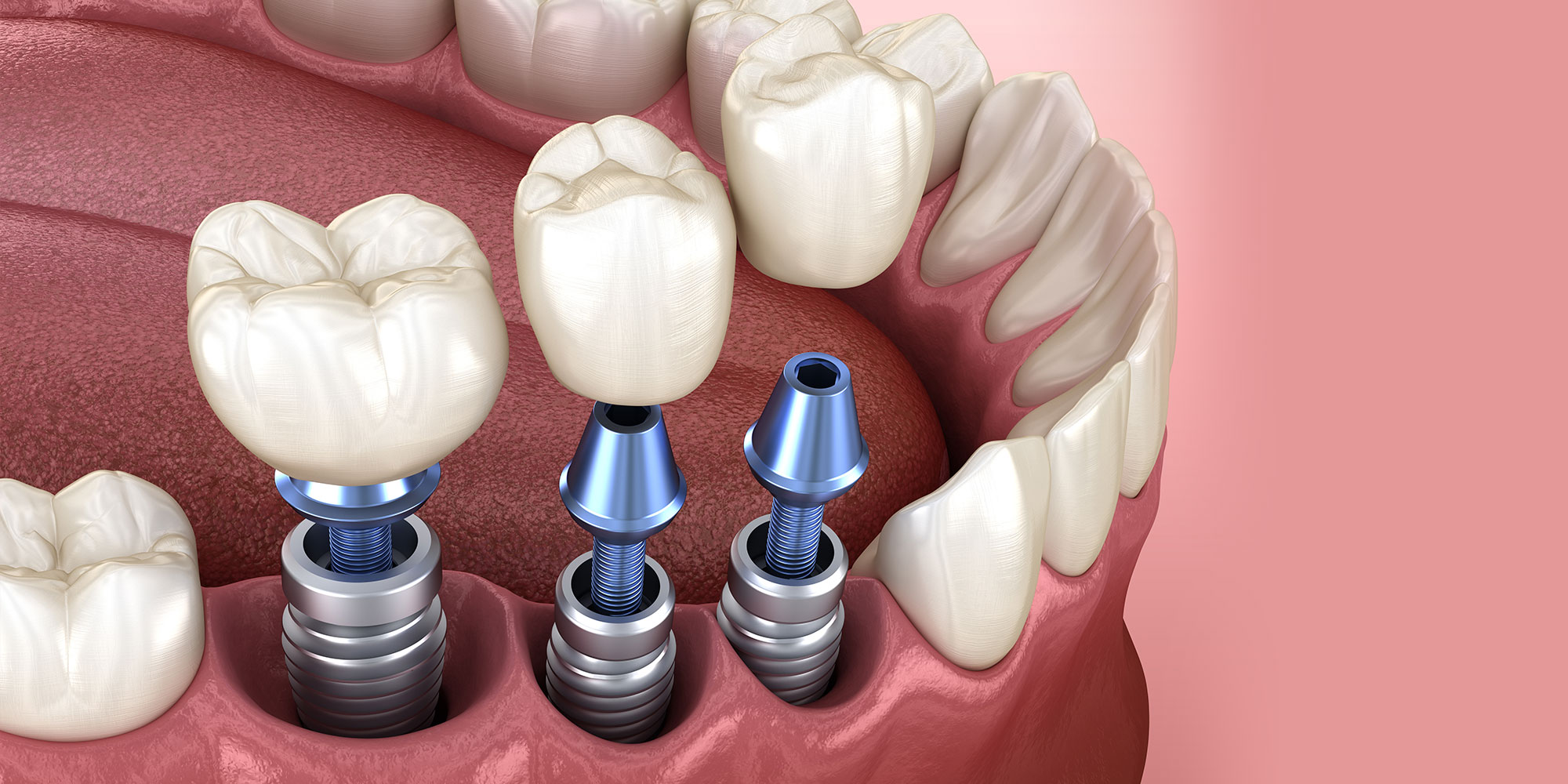 dental implants model