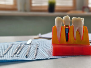3D illustration of a single-tooth dental implant demonstrates each procedure component—implant, abutment, and crown- separately.