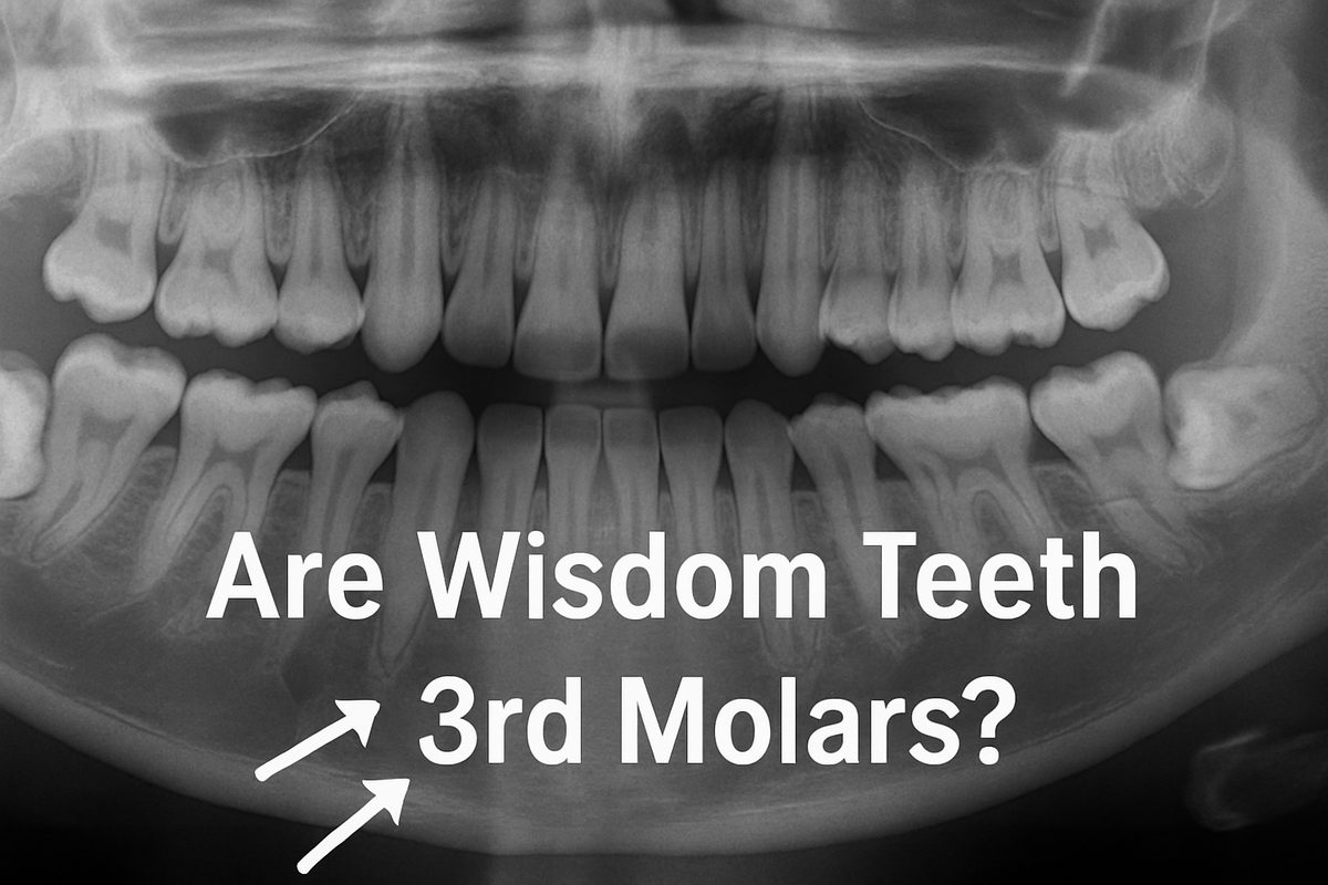 X-ray image showcasing impacted wisdom teeth (3rd molars) pressing against other teeth in the lower jaw. The image highlights potential crowding and alignment issues, with the words "Are Wisdom Teeth 3rd Molars?" displayed on the X-ray.