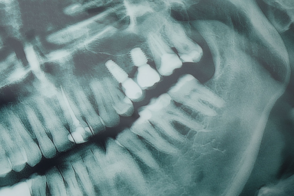 A close up of a dentist pointing to a dental implant x-ray with a patient. No text on the image.
