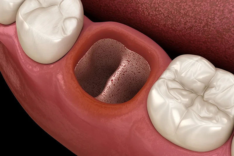 opened dry soket after tooth extraction. Medically accurate 3D illustration