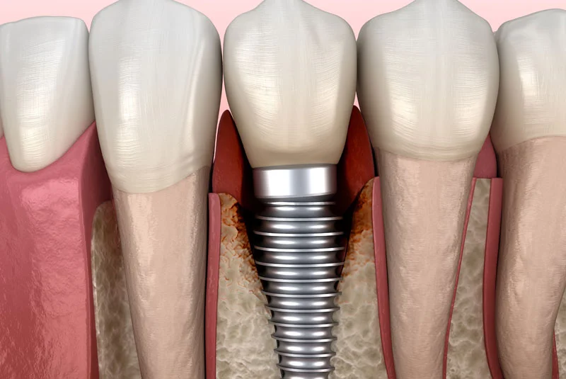 peri implantits