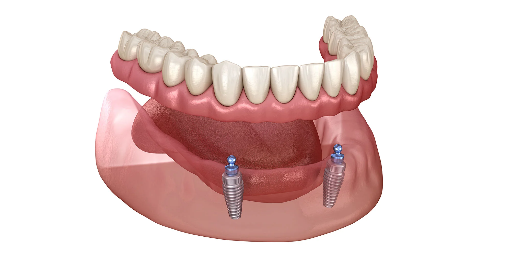 implant supported dentures