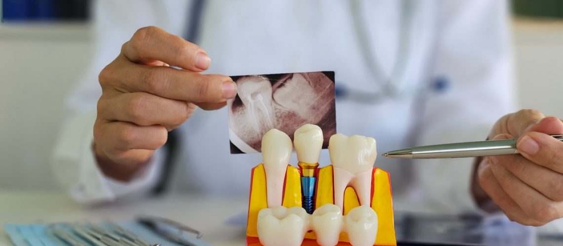 A 3D rendering displaying an oral implant being placed into a patient's lower jawbone, with emphasis on the surrounding bone structure. No text on the image.