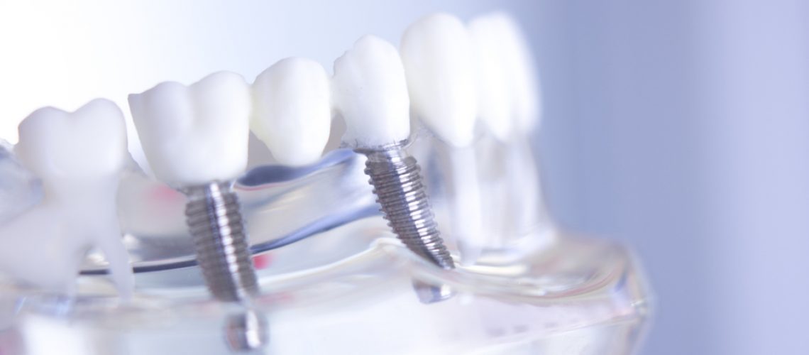 Oral surgeon consulting with a patient about full mouth dental implants