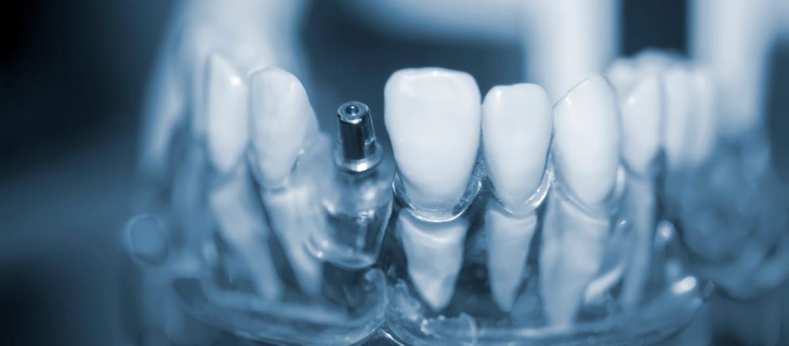 Image of a dentist consulting with a patient about dental implants, showing a 3D model of the patient's jaw with implant placement. No text on the image.