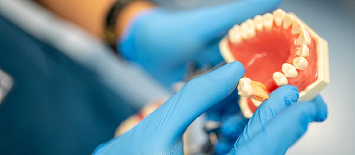 model of extracting a tooth, blue gloves dentist